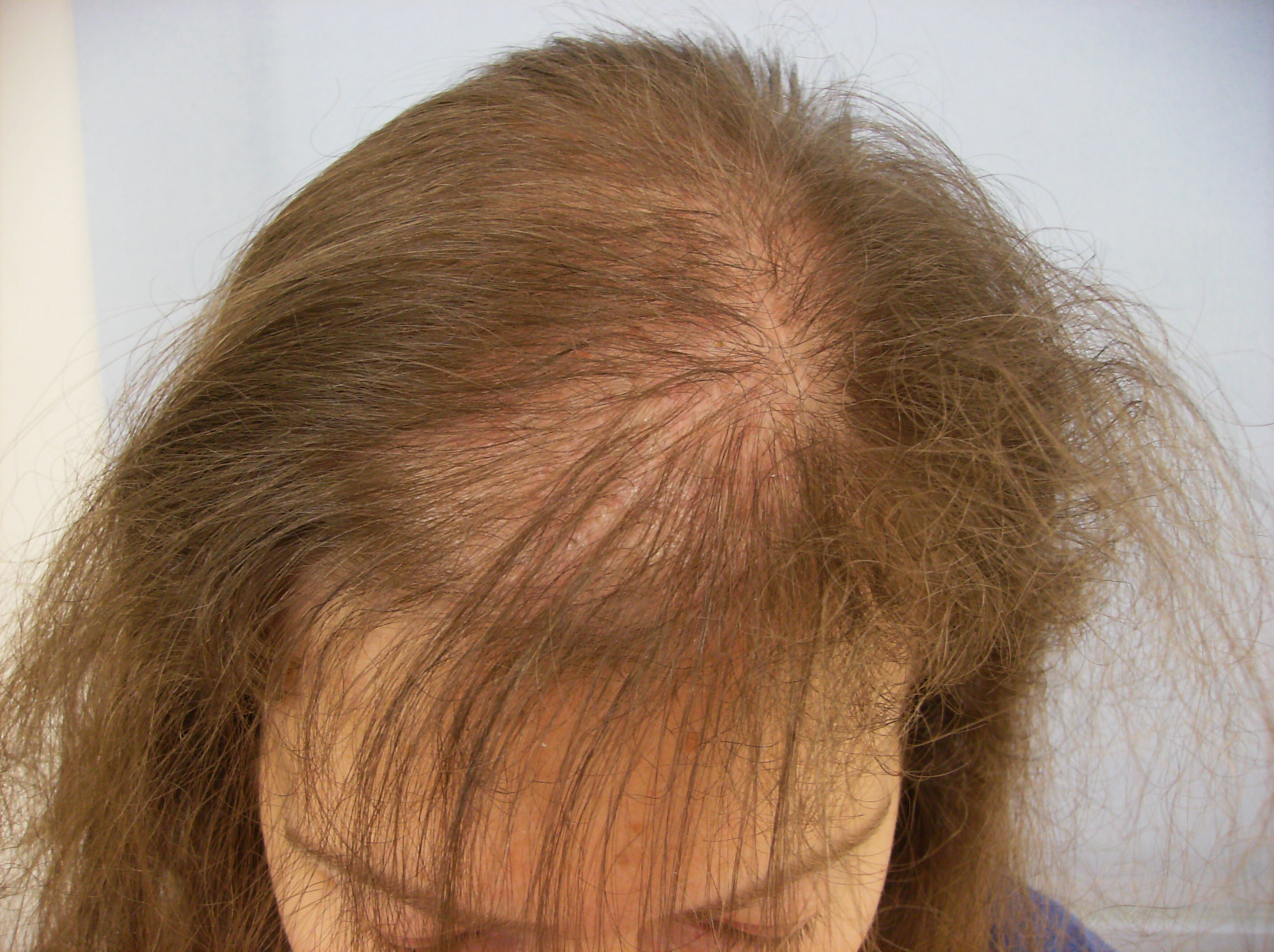 Alopecia Areata - Haarverzorging, Haaruitval ...