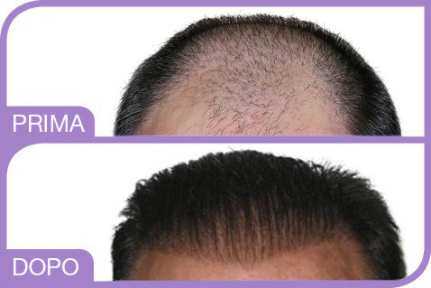 prima e dopo impianto capelli