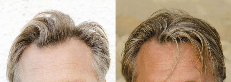 Impianto di capelli: le foto dei risultati - Medicap