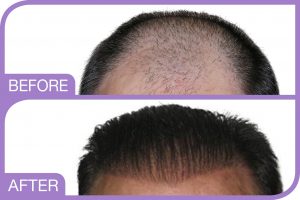 Hair implant, sure baldness solution - Medicap